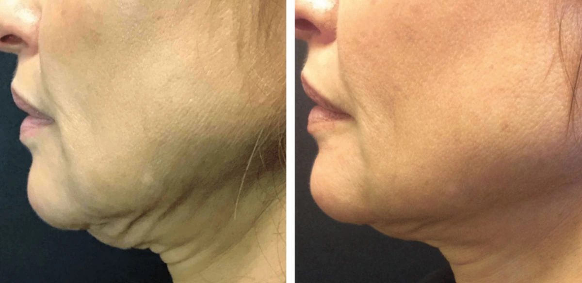 before-after-1-1200w