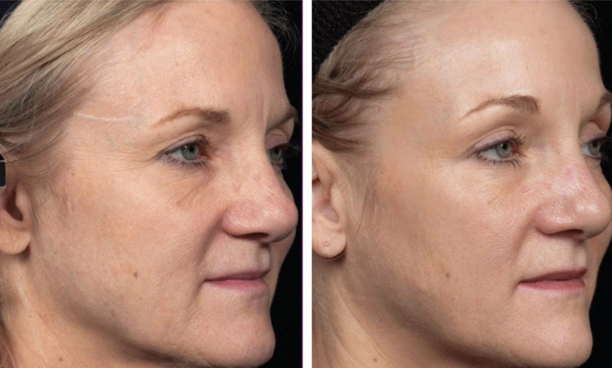 before-after-3-1200w