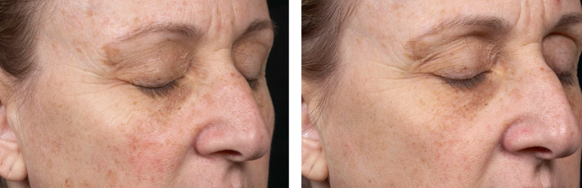 before-after-set2-01-1200w