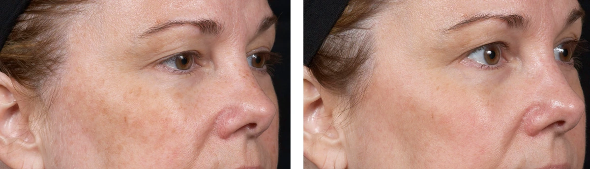 before-after-set2-02-1200w