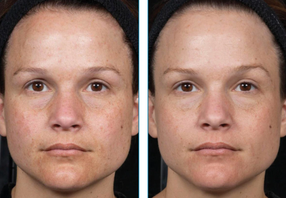 before-after-set2-04-1200w
