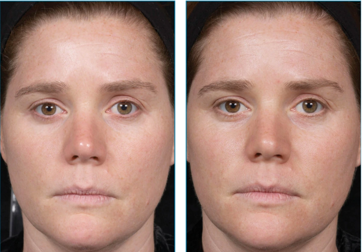 before-after-set2-05-1200w