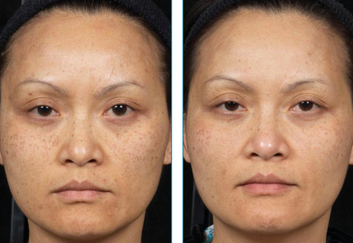 before-after-set2-06-1200w