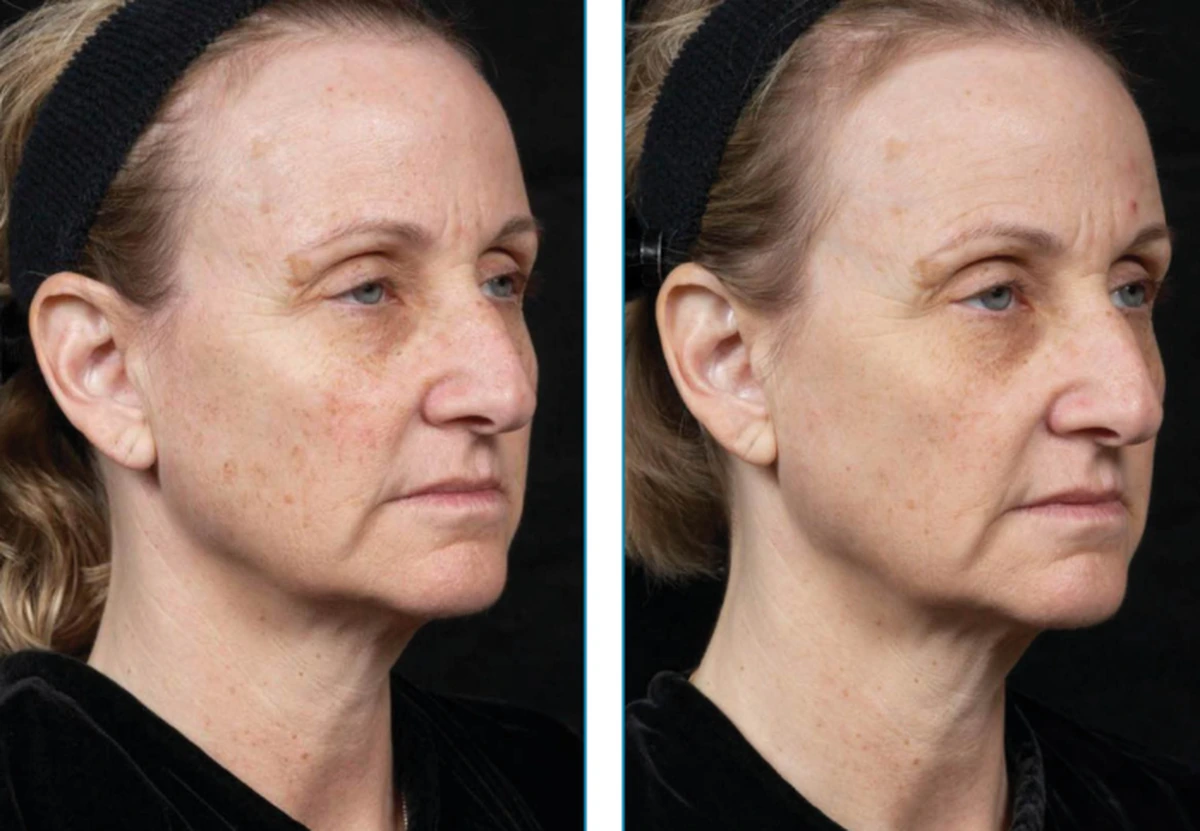 before-after-set2-08-1200w