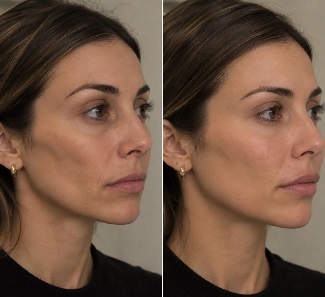 lumiere-dermal-filler-before-after