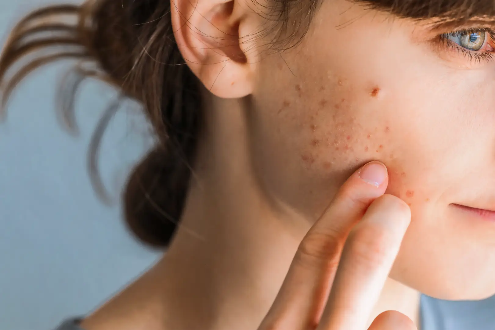Woman touches her cheek where small red marks, brown spots, and shallow indentations are visible.