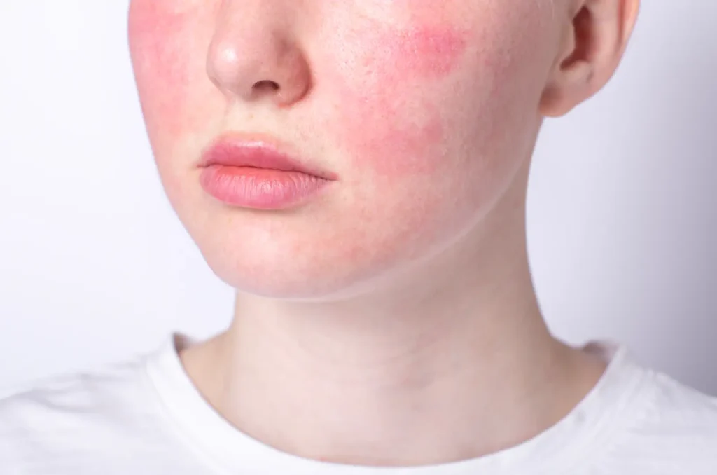 Close-up of a person with broad red patches across both cheeks and the sides of the nose.