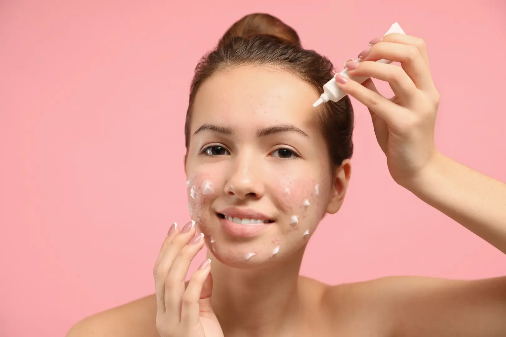 Woman holds a white tube while applying small dabs of cream to red areas on her cheeks and chin.
