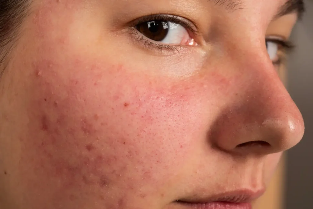 Close-up of a woman’s cheek with visible redness, small spots, pores, and uneven skin texture.