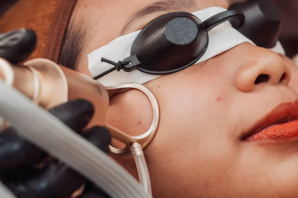 Woman wears black protective eye shields while a gloved hand holds a metal device beside her cheek.
